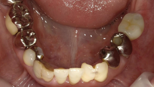 インプラント治療 - エミ内科歯科クリニック（太子町）